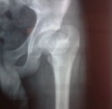 Femoral Ost1